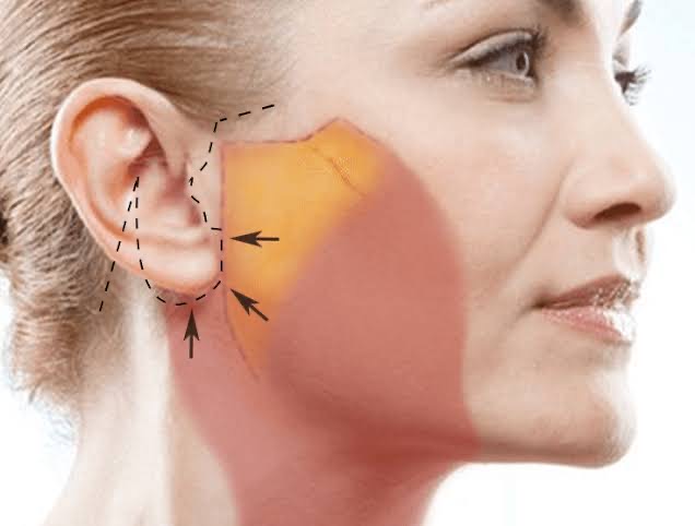 Método pouco difundido no Brasil rejuvenesce até 10 anos, afirma especialista