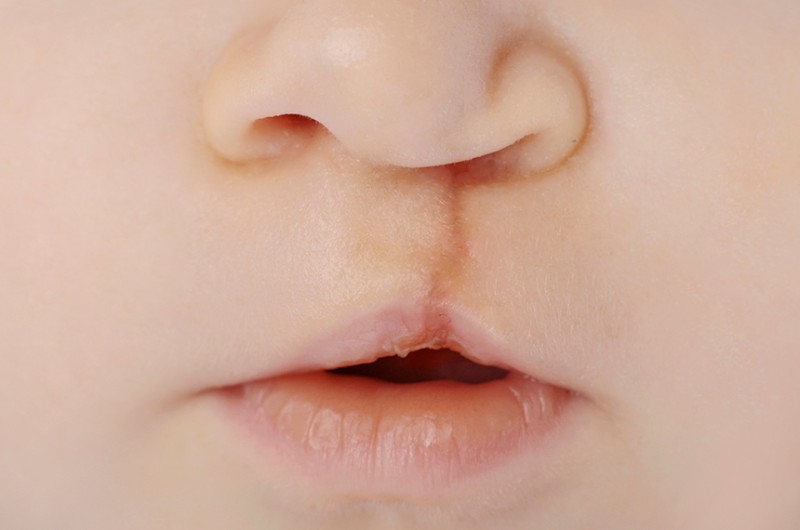 Também conhecida como lábio leporino, a fissura labiopalatina pode ser corrigida com cirurgia - Getty Images/iStockphoto